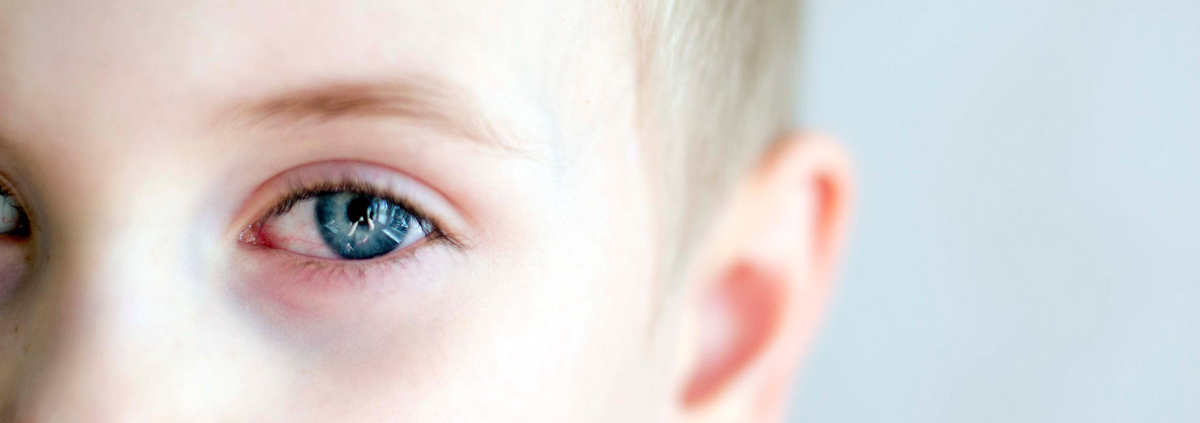 דלקת בלחמית העין אצל ילדים