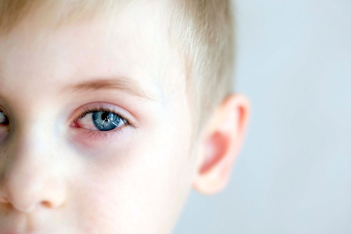 דלקת בלחמית העין אצל ילדים