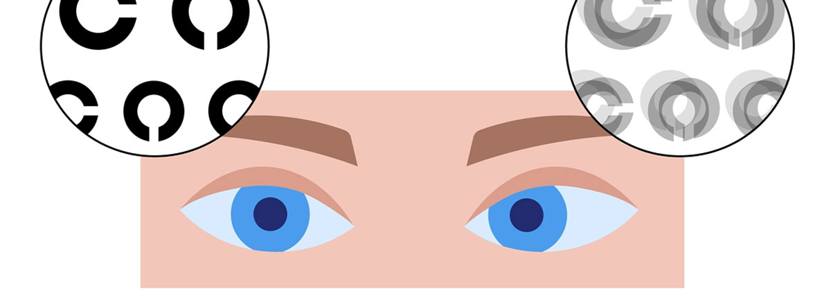 עין עצלה Amblyopia
