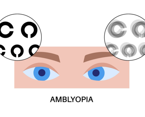 עין עצלה Amblyopia