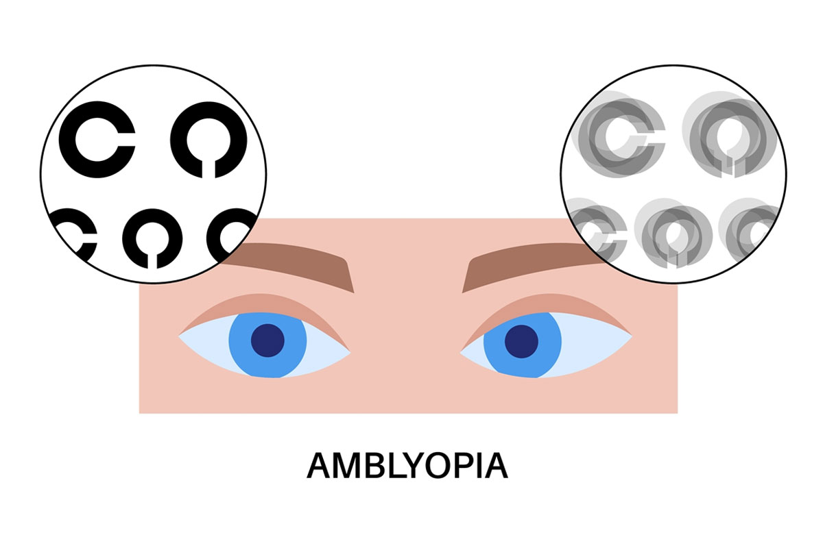 עין עצלה Amblyopia